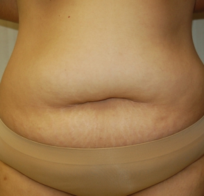 Abdominoplasty Patient Photo Gallery Austin Tx Plastic Surgery Center